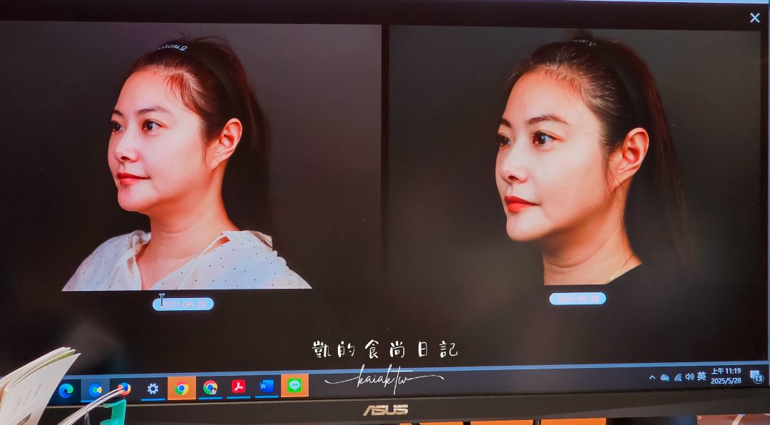 搶救下巴線條大作戰。士林容禾整形外科診所
